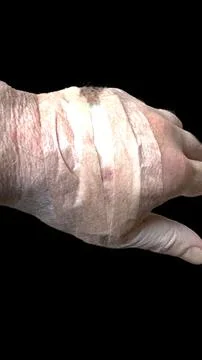 Mohs surgery on hand Foto stock