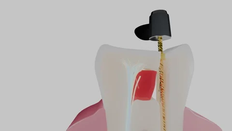 Molar cross section showing endodontic treatment on dark floor, 4K Stock Footage 346120965