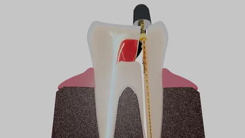Molar root canal treatment with rotary file and nerve fibers, 4K Stock Footage 346121041