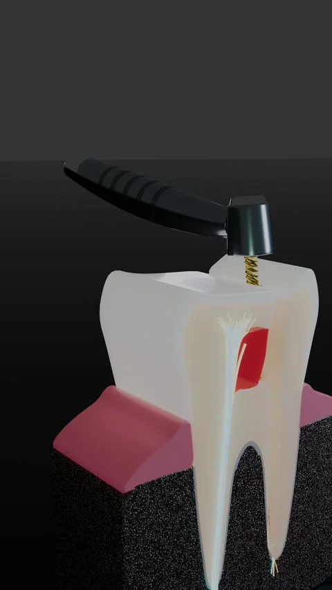 Molar root canal treatment showing rotary file in vertical, Vertical 9:16 4K Stock Footage 346121467