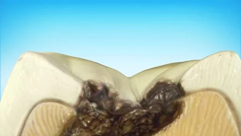 Molar teeth damaged by caries. Medically accurate tooth 3D animation Stock Footage 293625639