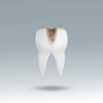 Molar Tooth Cavity Stock Illustration