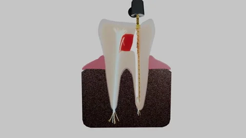 Molar tooth cross section with endodontic rotary file in root canal, 4K Stock Footage 346120674
