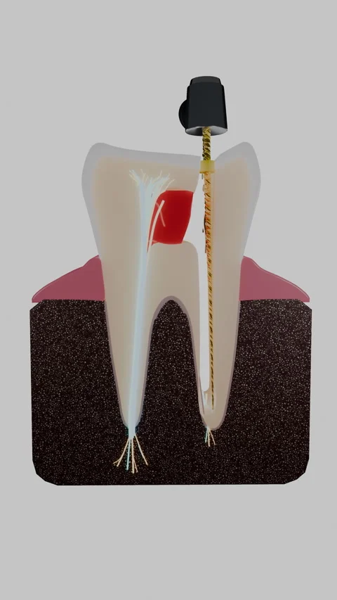 Molar tooth cross section with endodontic file in vertical, Vertical 9:16 4K Stock Footage 346121482