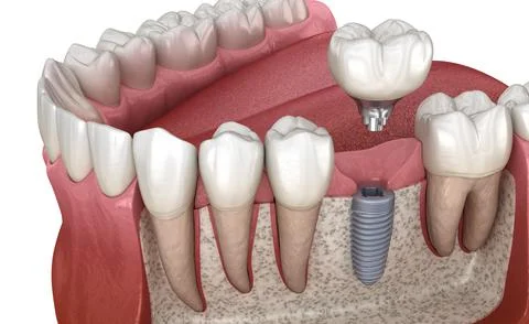 Molar tooth crown installation over implant abutment. Stock Illustration