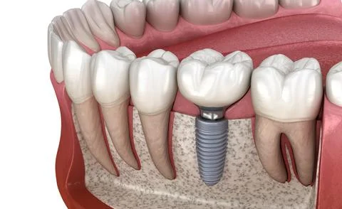 Molar tooth crown installation over implant abutment. Medically accurate 3D Stock Illustration