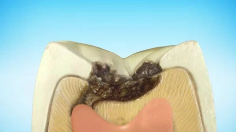 Molar tooth damaged by caries. Medically accurate tooth 3D animation Stock Footage 293745310