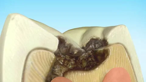 Molar tooth damaged by caries. Medically accurate tooth 3D animation Stock-Footage 294713282