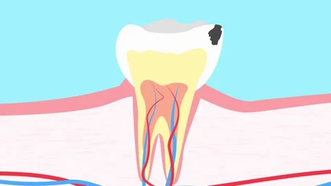 Molar tooth damaged by caries. Medically accurate tooth 2D animation. Tooth Stockbeeldmateriaal 301600992