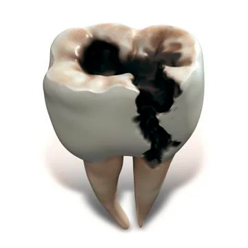 Molar tooth decay Stock Illustration