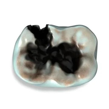 Molar tooth decay Stock Illustration