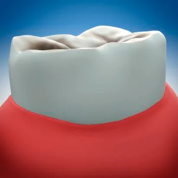 Molar tooth decay, illustration Stock Illustration