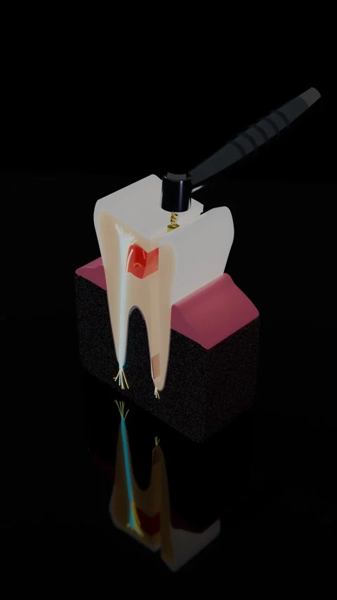 Molar tooth root canal therapy with dental instrument, Vertical 9:16 4K Stock Footage 346120614