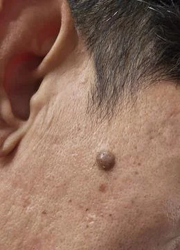 A mole on the face seen up close that enlarges and grows hairs Stock Photos