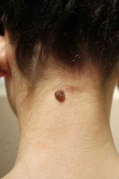 Mole Stock Photos