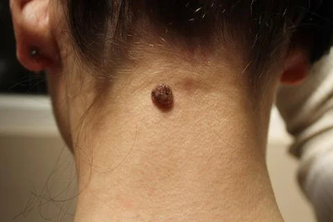 Mole Stock Photos