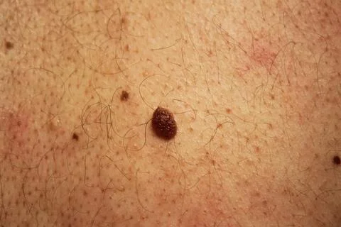 Mole Stock Photos