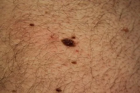 Mole Stock Photos