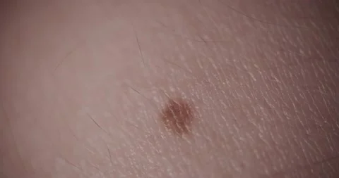 A mole on the skin Video stock 166654151
