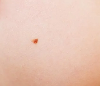 Mole on skin Stock Photos