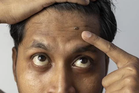 Mole - a skin problem Stock Photos