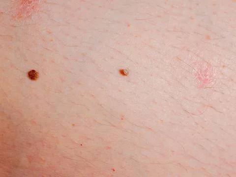 Mole  a soft, pigmented mole protruding above the skin surface, close-up mc.. Stock Photos