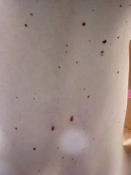 Moles on the back Stock Photos