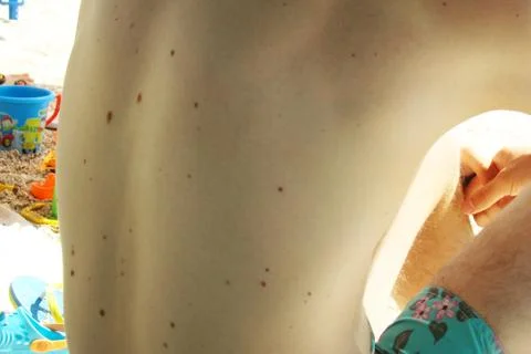 Moles on the back Stock Photos