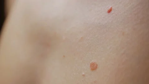 Moles On The Body Stock Footage 165796313