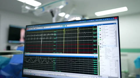 Monitor of the computer with diverse curved lines changing shape. Surgical room Stock Footage 331081508
