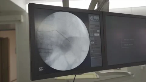 Monitor for neurosurgical operations. Microscope. Stock Footage 149770689