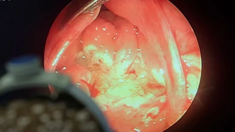 Monitor, operating room, operation to remove tonsils in patient’s nasopharynx Stock Footage 128643009