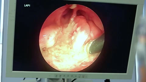 Monitor in operating room, operation, remove tonsils in patient’s nasopharynx Video stock 132725884