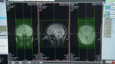 On the monitor screen a doppler of the brain Vídeos de archivo 113693893