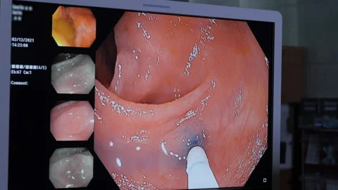 Monitor screen of endoscopy removal of polyp in intestine Stock-Footage 167221577