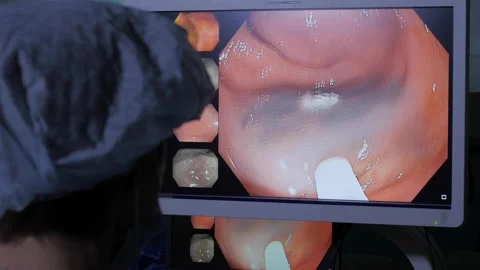 Monitor screen of endoscopy removal of polyp in intestine Video stock 167355130