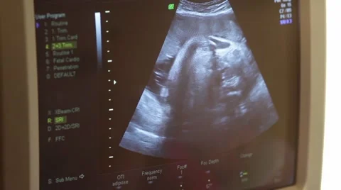Monitor screen showing live results of an ultrasound Stock Footage 60055638