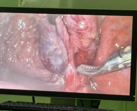 Monitor View During Laparoscopic Cholecystectomy C1 Stock Photos