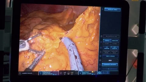 MONITORING ARMS FROM SURGERY MACHINE OPERATING ADIPOSE TISSUE WITHIN HUMAN BO Stock Footage 201741614