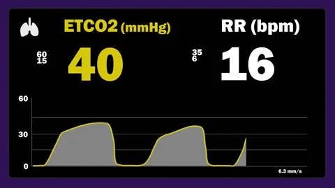 Monitoring Capnography - ETCO2 Stock Footage 148508420
