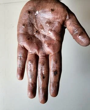 Monkey Pox Virus transmitted in human body Stock Photos