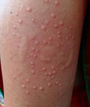 Monkey Pox Virus transmitted in human body Stock Photos