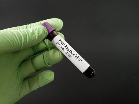 Monkeypox Blood Test Stock Photos