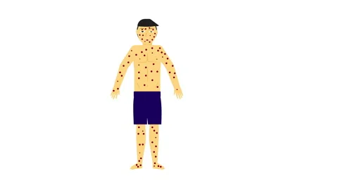 Monkeypox Stock Footage 195328458