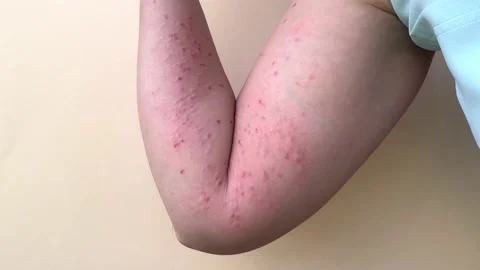 Monkeypox new disease dangerous over the world. Patient with Monkey Pox. Stock Footage 197006663