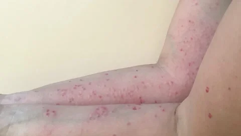 Monkeypox new disease dangerous over the world. Patient with Monkey Pox. Stock Footage 197006717