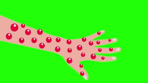 Monkeypox Rashes Popping, Affecting the Hand Animation on Green Background Stock Footage 283398005