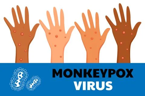 Monkeypox virus poster. Web banner of monkey pox skin infection of person. Stock Illustration