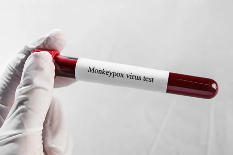 Monkeypox virus test. Laboratory worker holding sample tube with blood on l.. Stock Photos