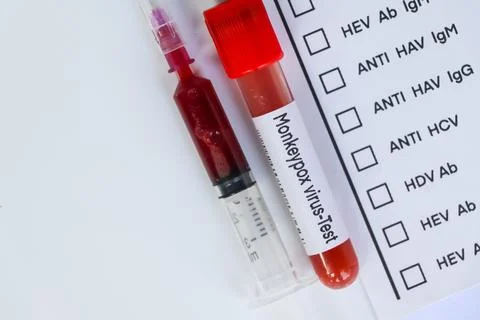 Monkeypox virus test to look for abnormalities from blood Stock Photos